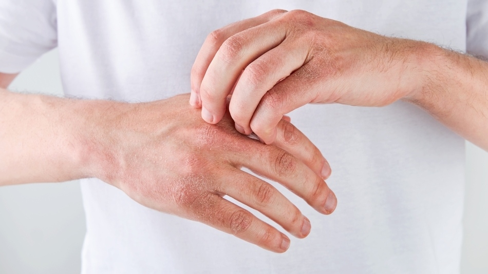 Los s&iacute;ntomas de la psoriasis pueden manifestarse, por ejemplo, a trav&eacute;s de placas rojas bien definidas, cubiertas por escamas blanquecinas que se desprenden con facilidad