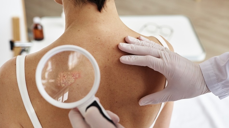 La psoriasis es una enfermedad que modifica la velocidad de renovación de la piel y causa lesiones visibles que pueden afectar la comodidad física y emocional