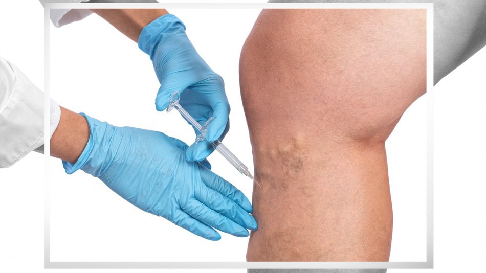 Las varices son una de las afecciones que estudia la flebolog&iacute;a