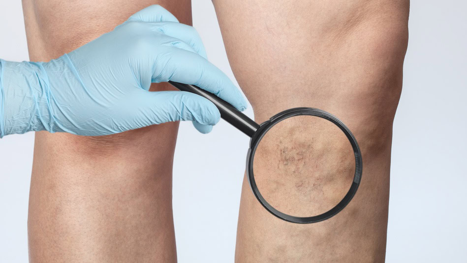 La flebología es una rama de la medicina que se dedica al estudio de las venas